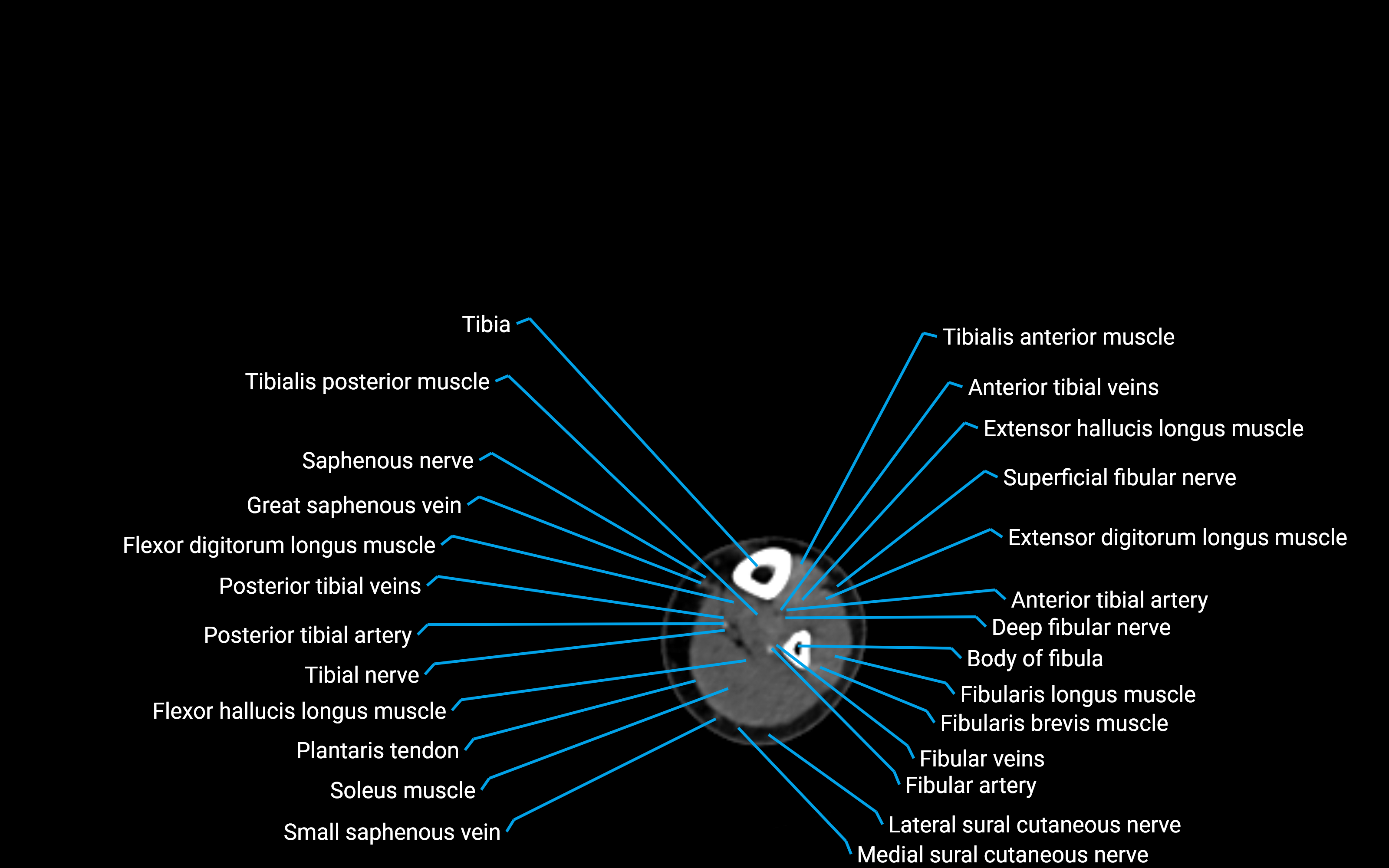 CT Lower leg axial cross sectional anatomy labelled image 138 (2).png